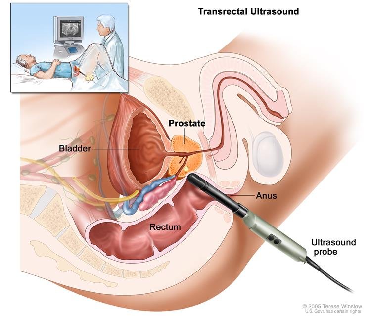 prostate 4 szakasz)