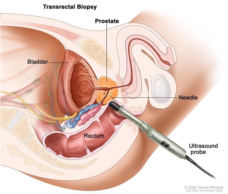 prosztatarák kezelése injekcióval prostata mrt auswertung