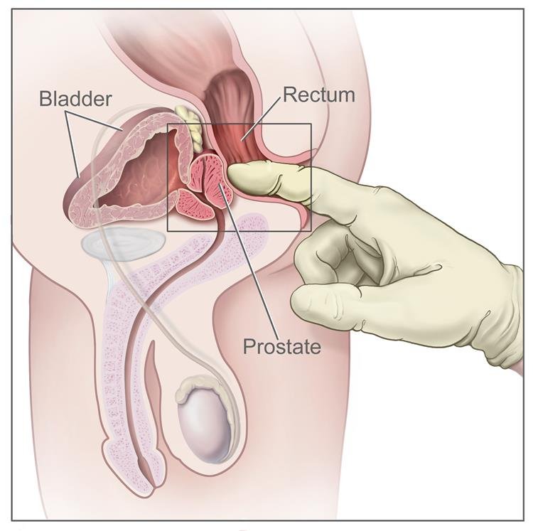a rectum prosztata vérével