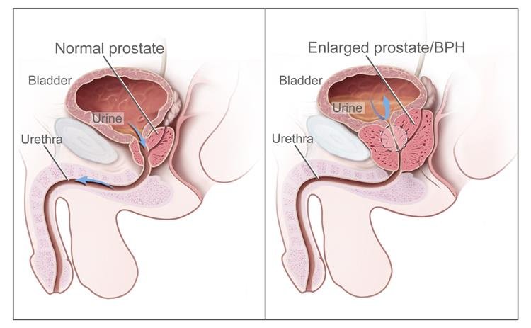 prostatitis a férfiak vérében amikor vizeletet krónikus prostatitis ed