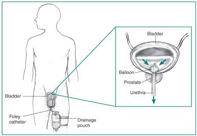 katéter a prostatitis férfiak számára