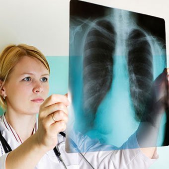 megmagyarázhatatlan fogyás mellkasröntgen